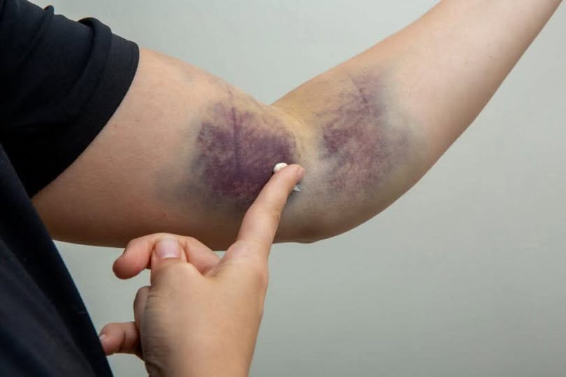 Bruises Without Injury: Kya Bina Chot Lage NeeL Parhne Ka Matlab Hai?
